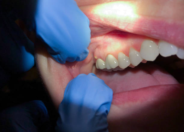 Best Emergency Dental Care for Broken or Chipped Teeth in Cochran, GA